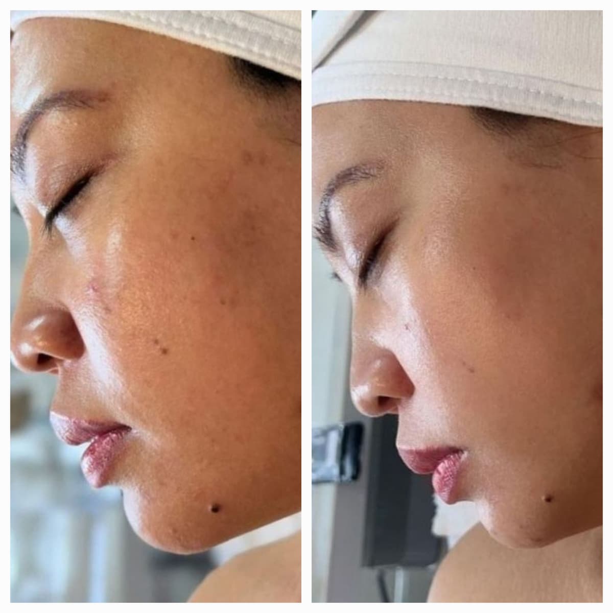 Acne Treatment results - Face