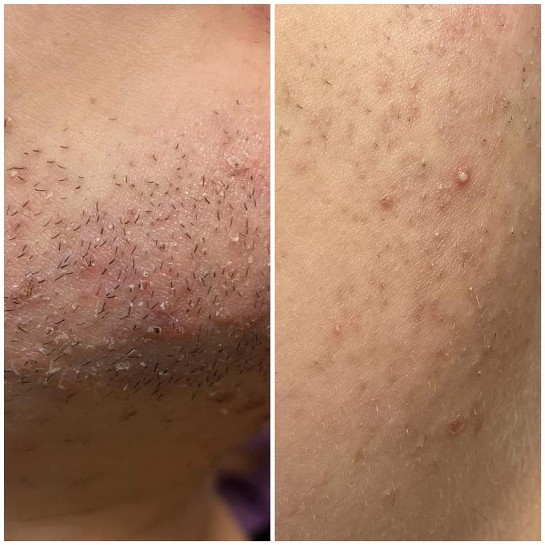 Laser Hair Removal results - Legs