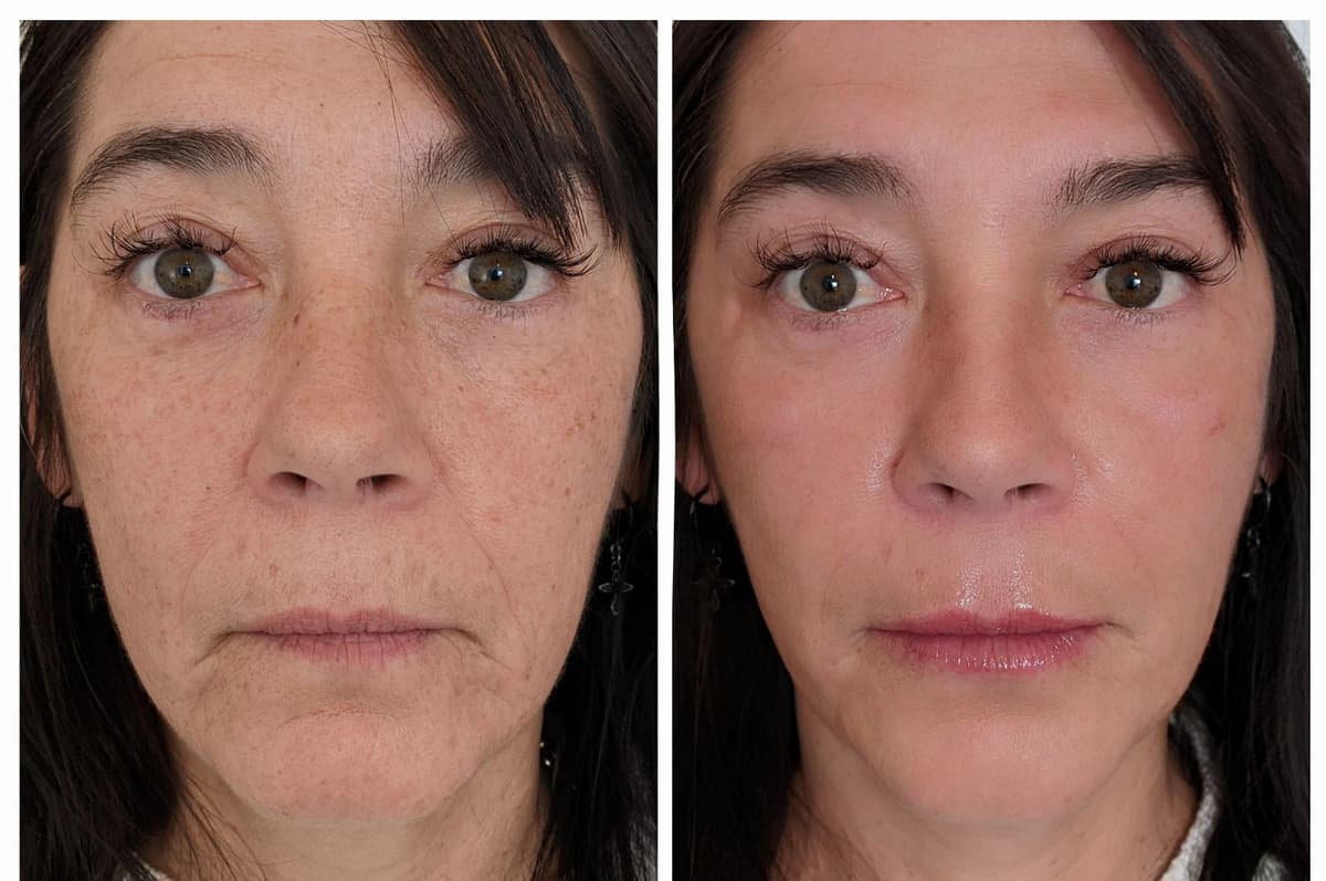 Micro-Needling with E-Pen results - Treatment Area