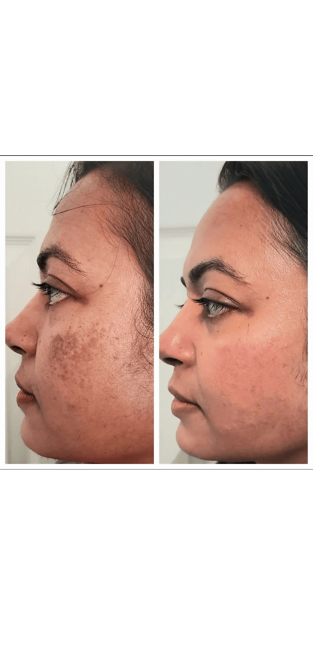 PRP Treatment results - Scalp